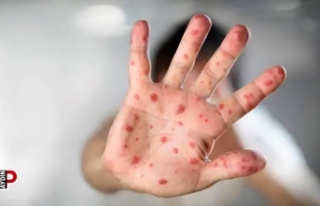 Kızamık çocuklar arasında hızla yayılıyor